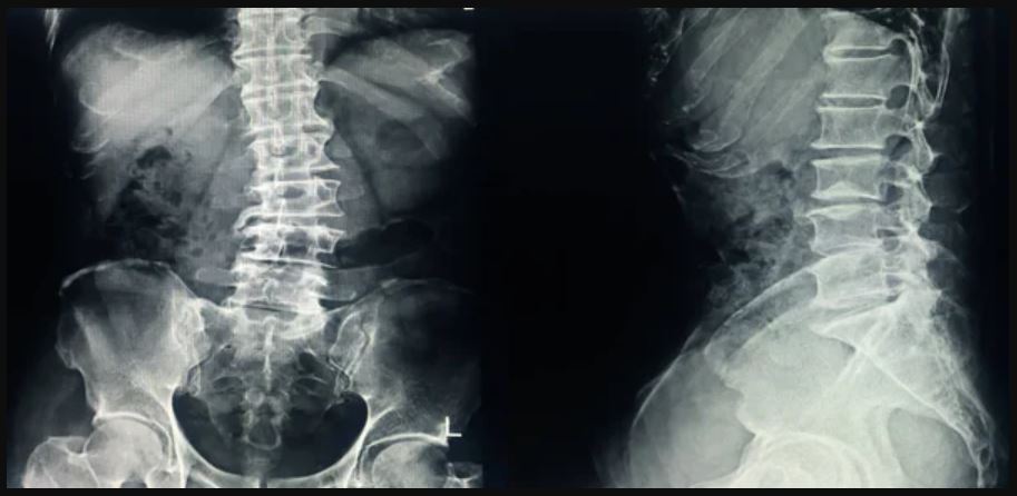 Foto Rontgen Tulang Dengan Indikasi Skoliosis