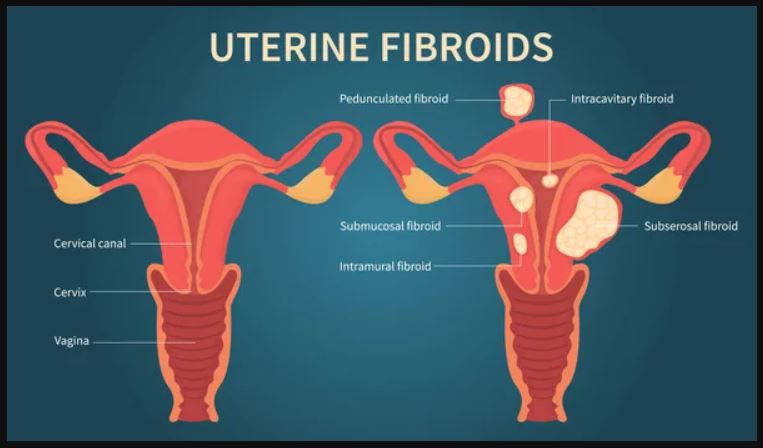 Miom Atau Uterine Fibroid