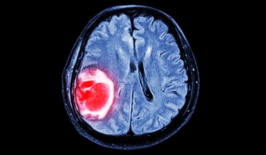 Perkiraan Biaya Operasi Tumor Otak Dengan Bpjs