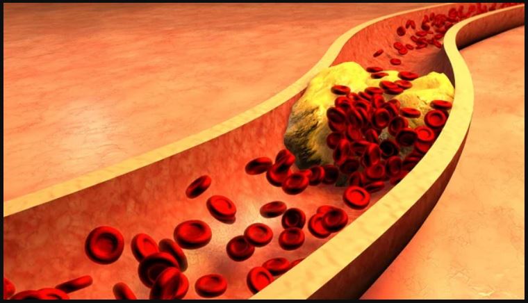 Plak Kolesterol Dalam Pembuluh Darah
