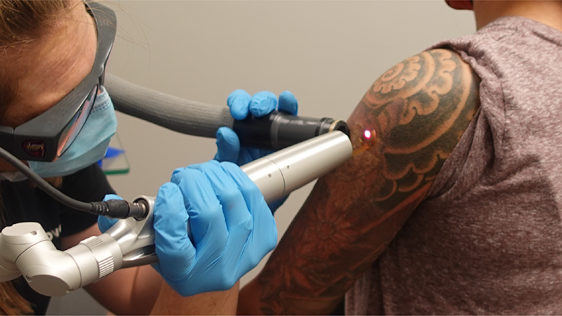 ONE SESSION of Tatt2Away Tattoo Removal at Black Lotus Tat  Flickr