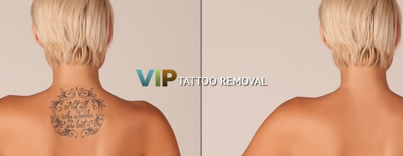 Tattoo Removal (2) in Henderson NV
