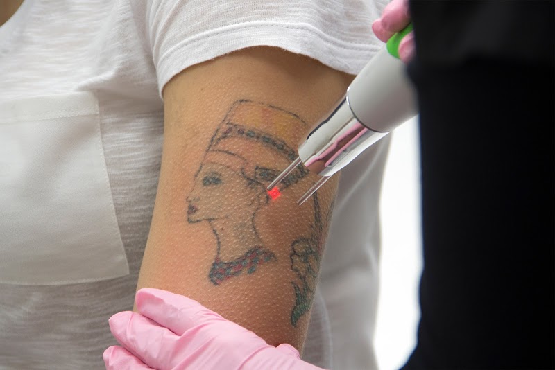 Tattoo Removal (2) in Kansas City MO