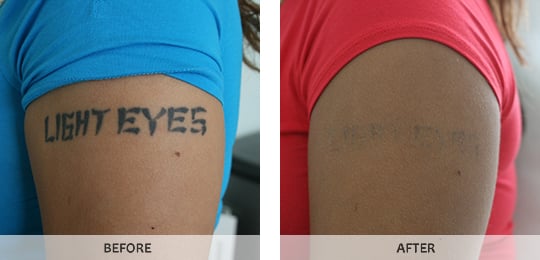 Tattoo Removal (3) in Jersey City NJ