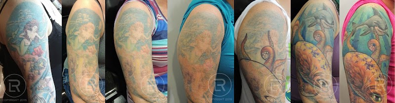 Tattoo Removal (3) in St. Paul MN