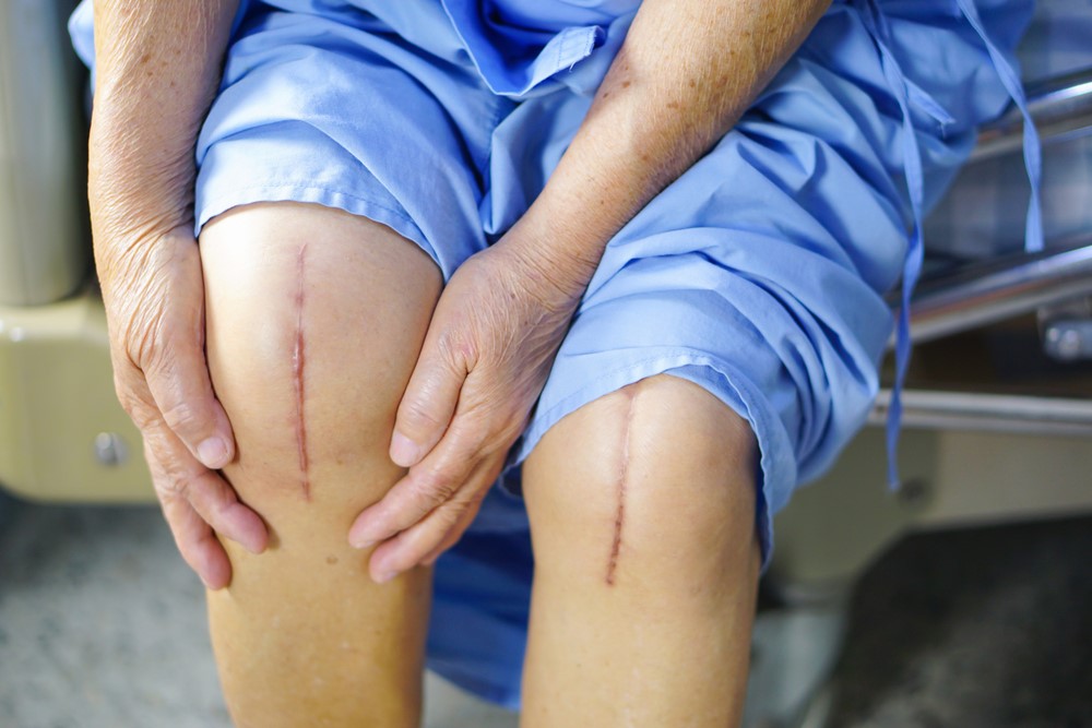 Cover Top 5 Mistakes After Knee Replacement